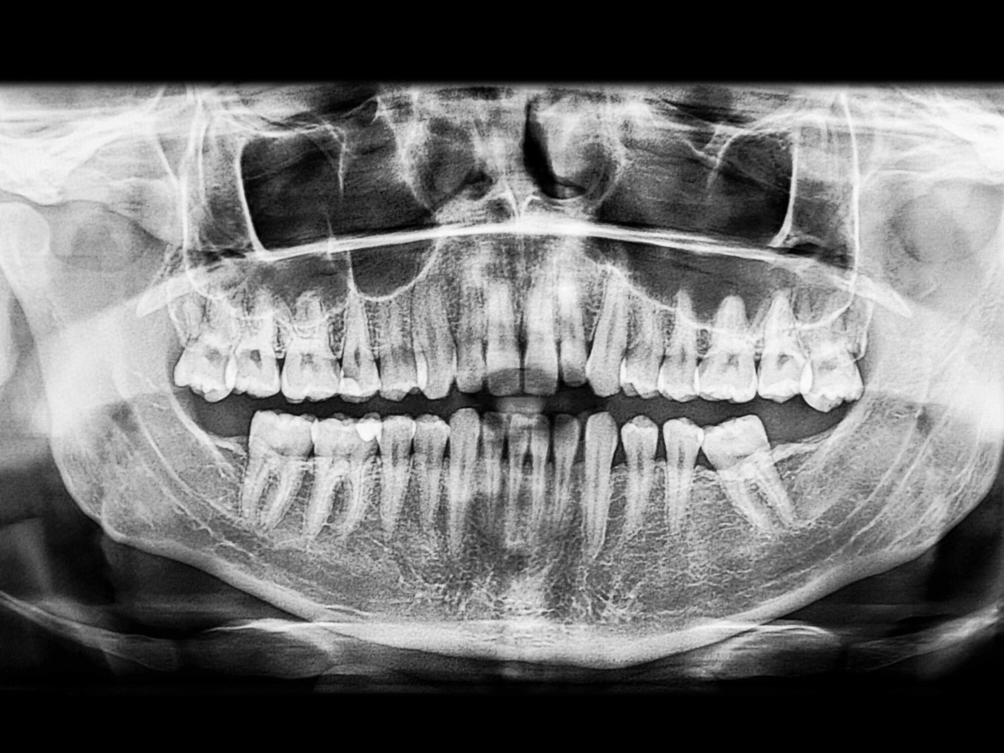 Radiografia panoramica delle arcate dentarie su fondo nero, esempio di immagine bidimensionale