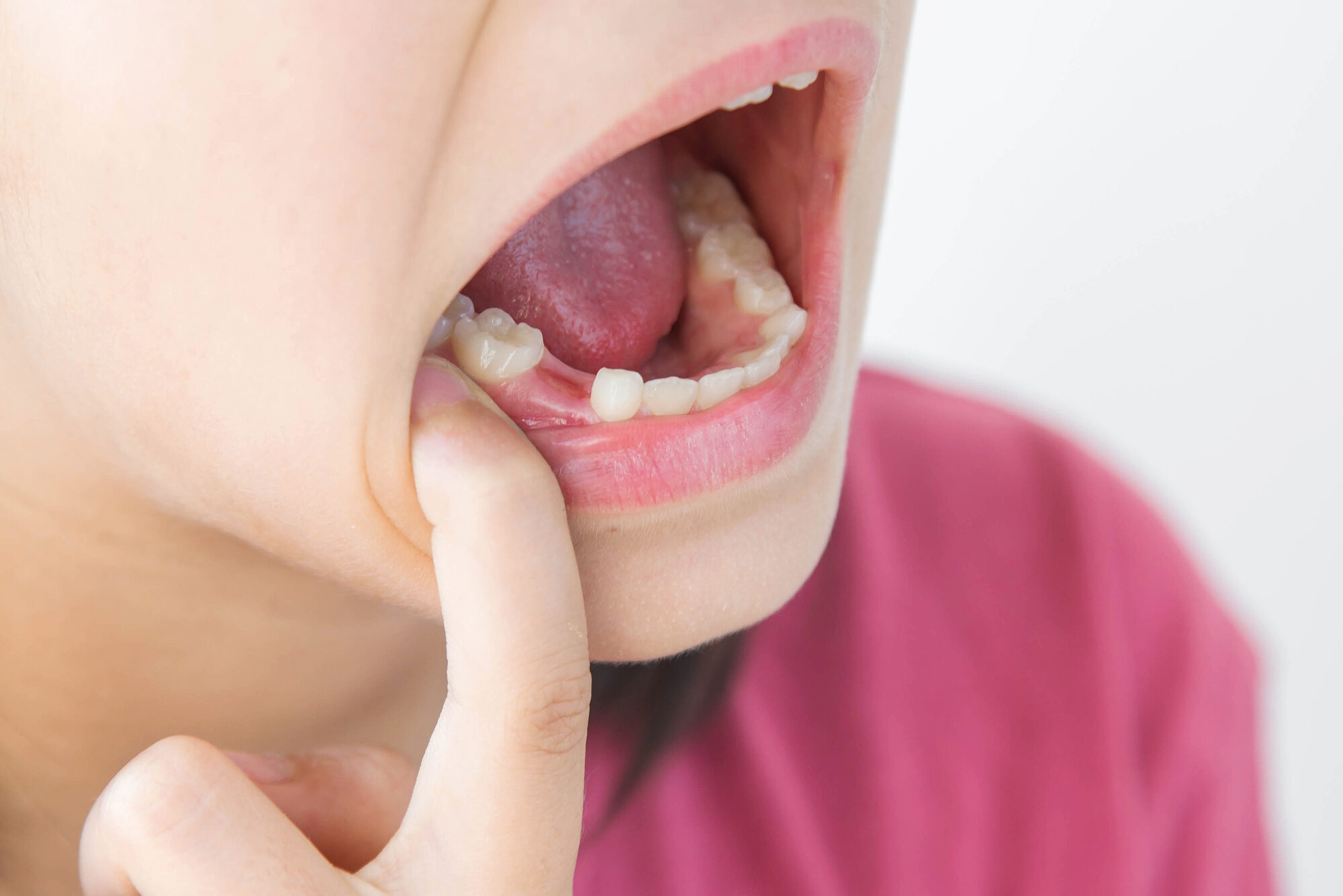 Bocca di un bambino con lo spazio lasciato da un dente da latte caduto