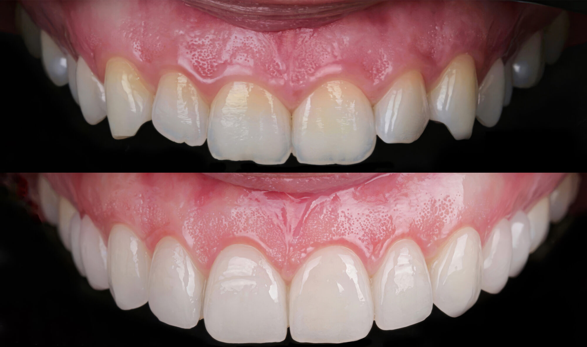 Confronto intraorale del settore dentale anteriore