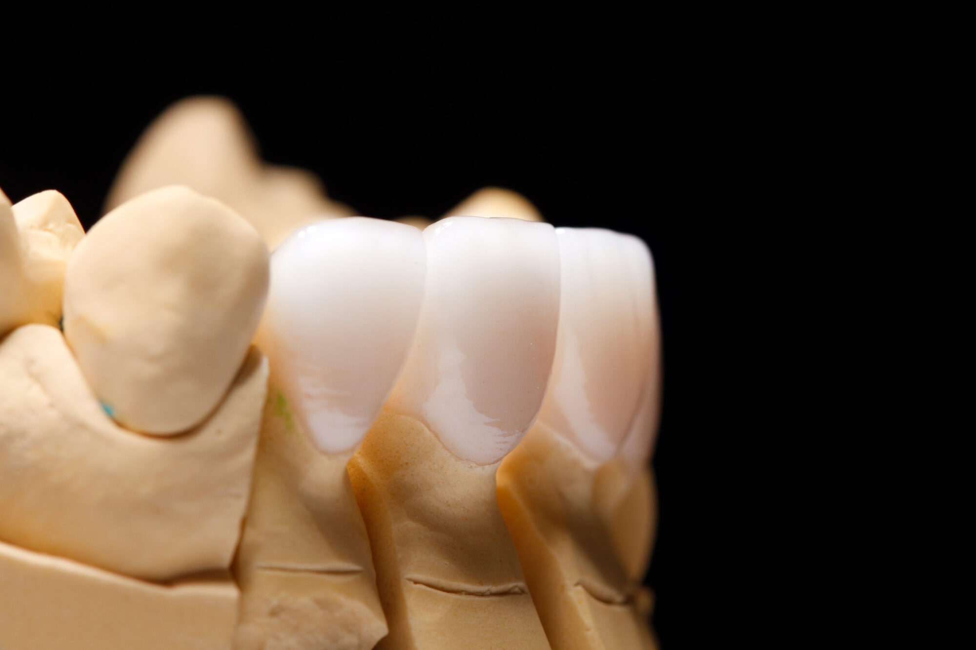 Faccette anteriori in ceramica montate su un modello diagnostico