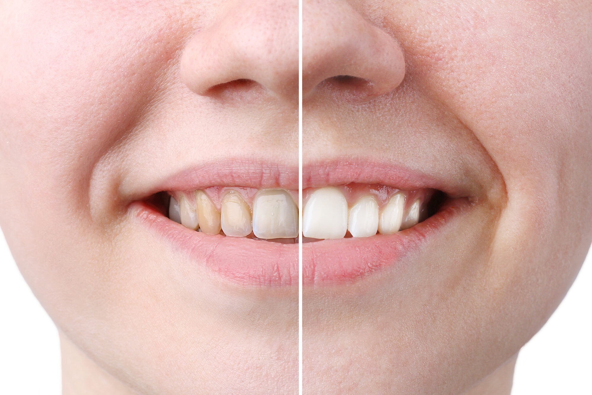 Confronto ravvicinato del colore dei denti prima e dopo uno sbiancamento dentale
