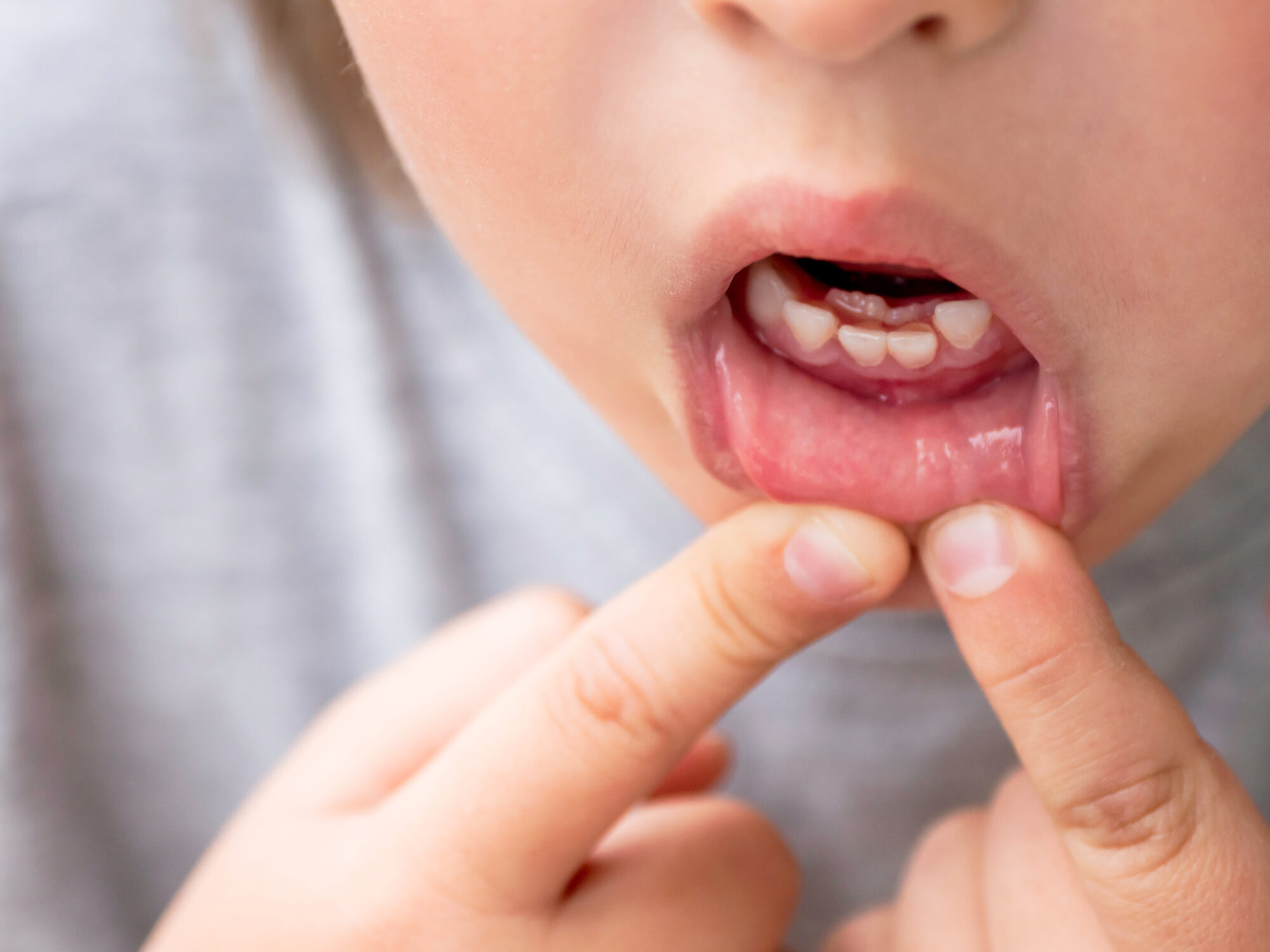 Bocca di un bambino con un dente permanente spuntato dietro un dente da latte ancora presente