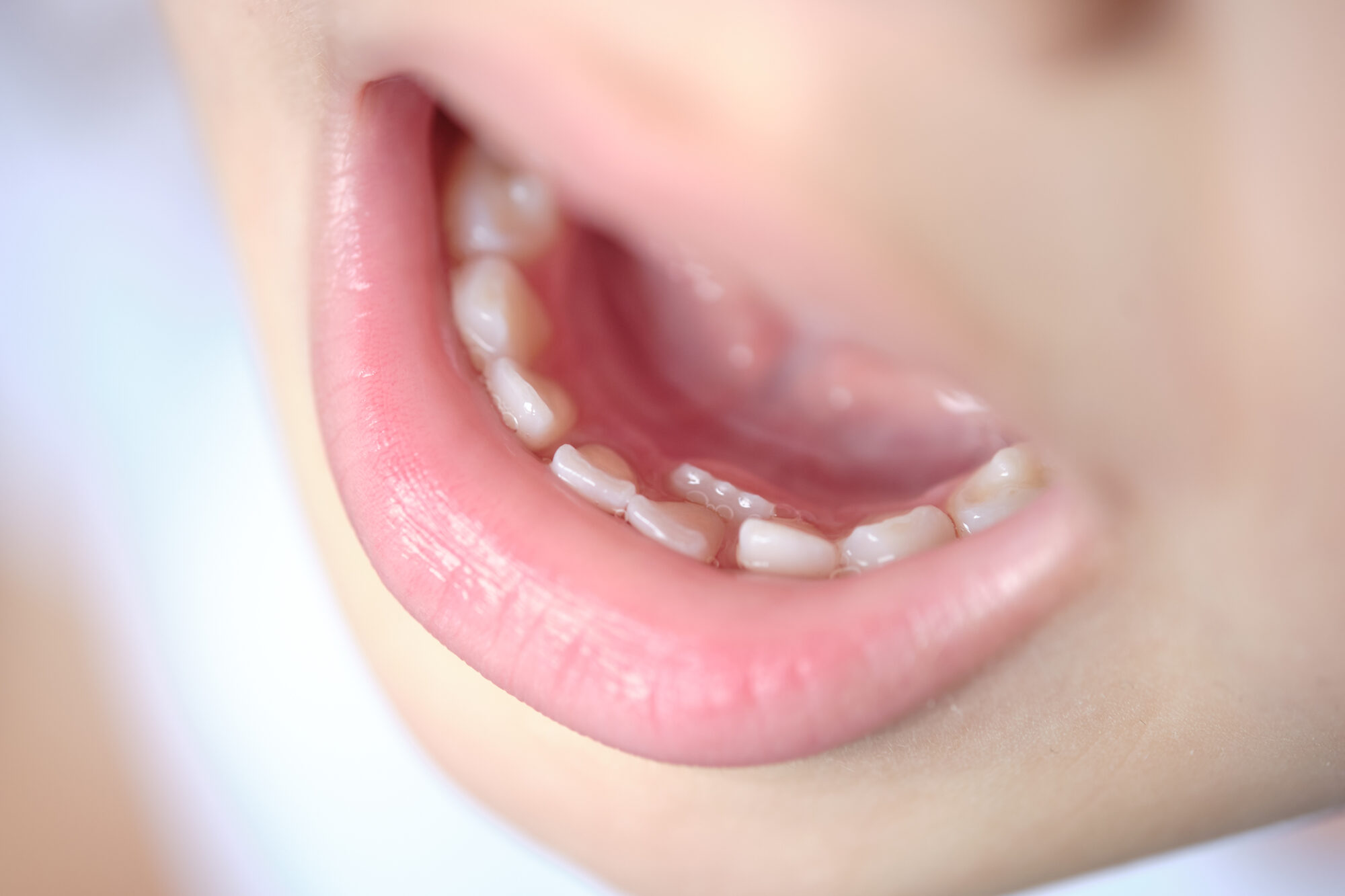 Bocca di un bambino con i denti da latte e i primi permanenti in arrivo