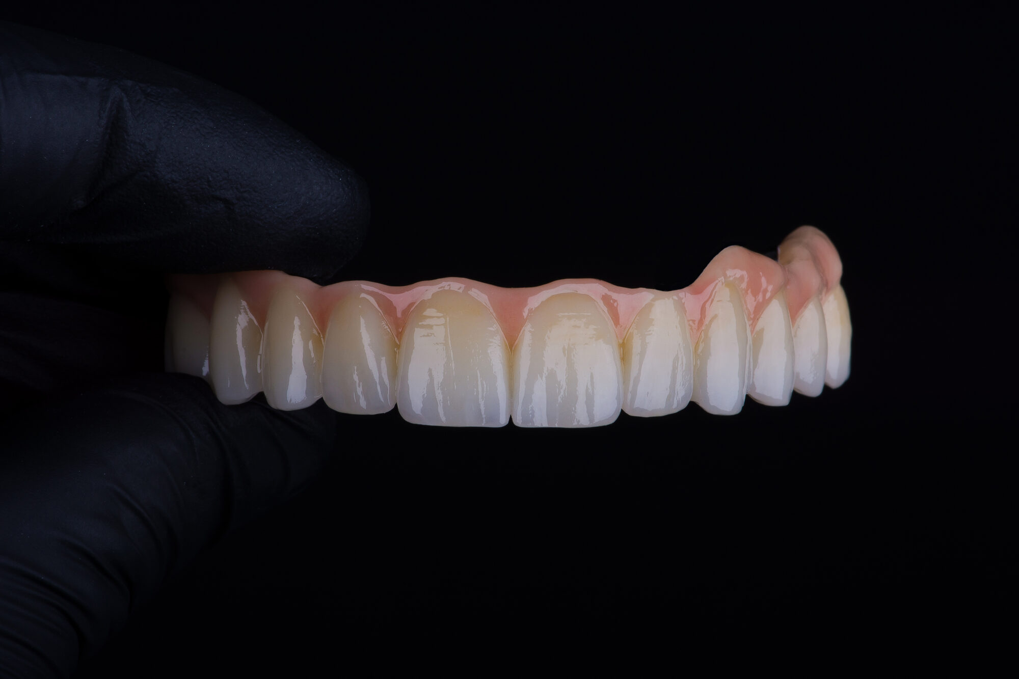 Protesi completa in zirconio su barra in titanio, in due fasi di lavorazione: la struttura grezza prima della sinterizzazione e la versione stratificata e colorata.