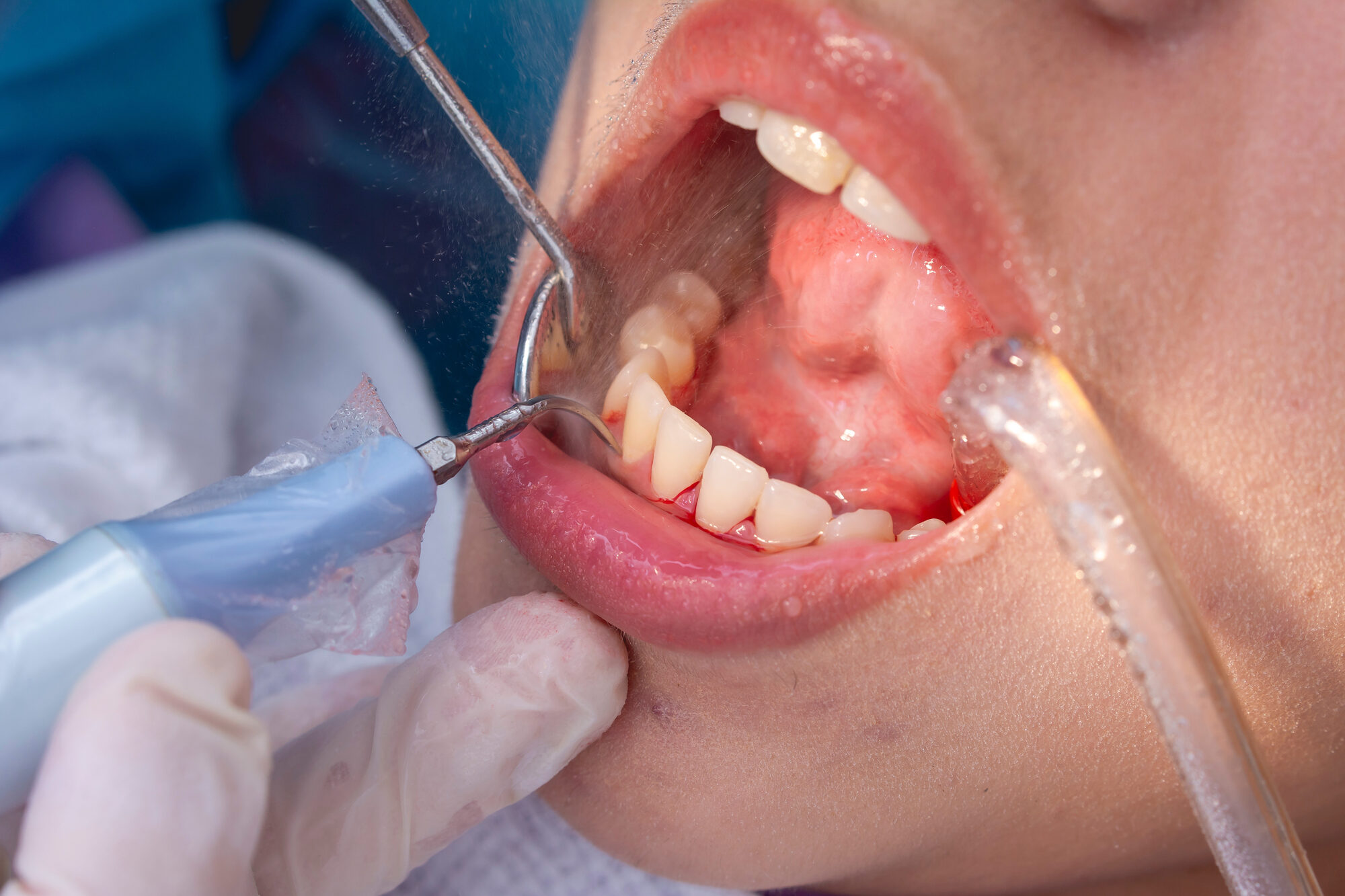 Seduta di igiene professionale: uno scaler manuale rimuove la placca fra gli incisivi inferiori, con specchietto per la visibilità e aspirasaliva.
