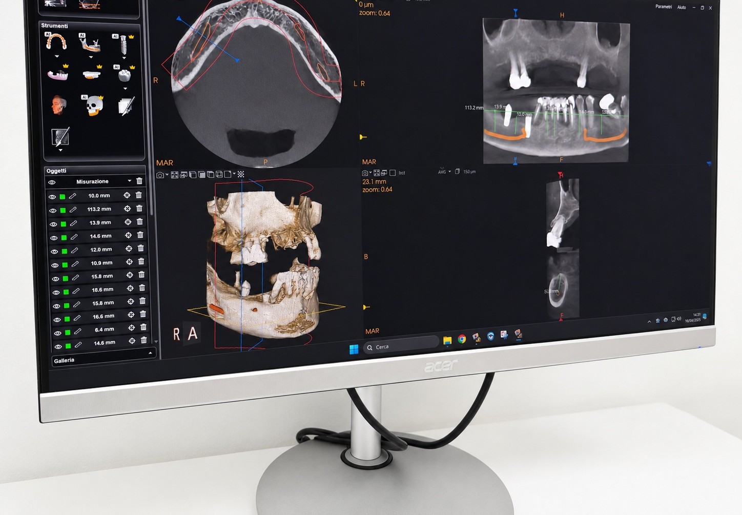 Schermo con ricostruzione tridimensionale e misurazioni ottenute dalla CBCT dello Studio